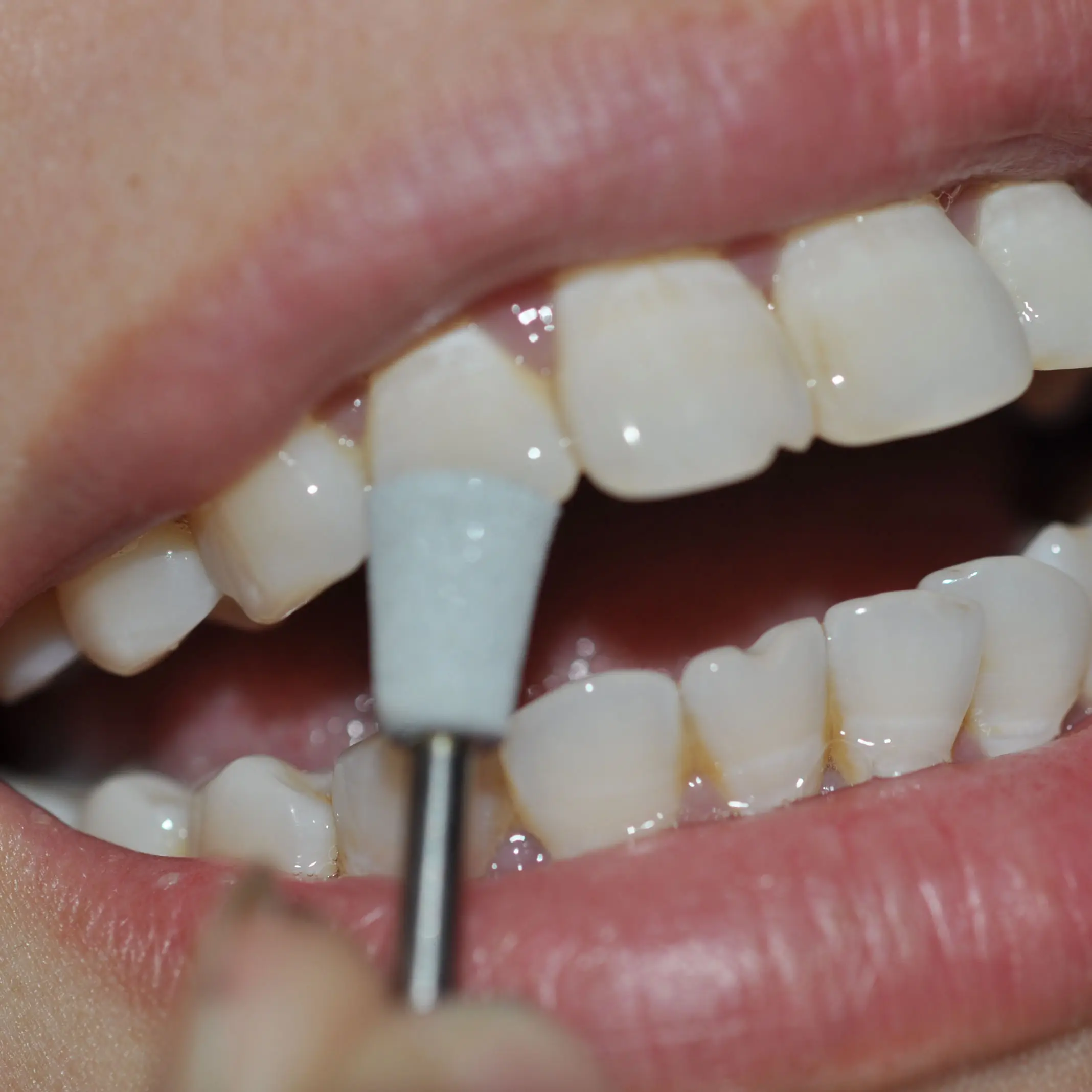 Toboom diş aletleri kiti diş İmplant cerrahi aracı setleri pembe el aleti
