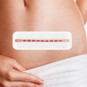 Y tế tùy chỉnh dùng một lần vô trùng Dải gia cố da dây kéo vết thương da đóng cửa thiết bị - Product Image 4