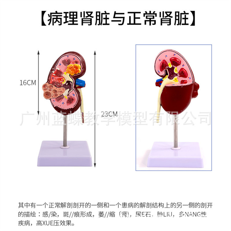 Modelo de anatomía renal patológica
