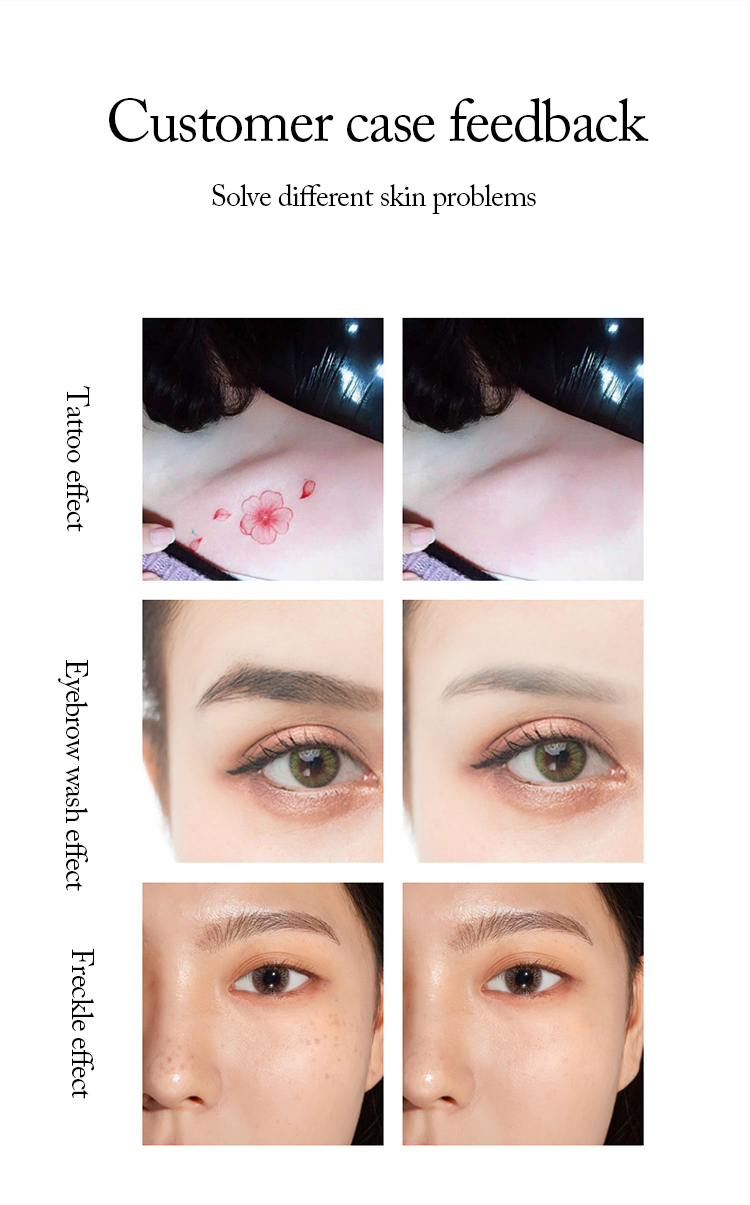 Portable Ultrasound Pico Laser Machine Laser 1064nm 532nm