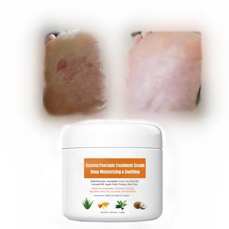 Creme hidratante para tratamento de psoríase, eczema, alívio suavizante, para dermatites, coceiras, limpeza seca, rachada, pele irritada