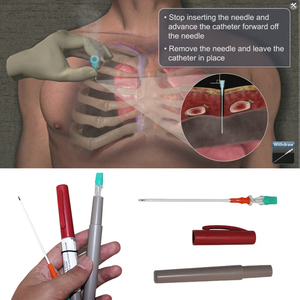 Medresq sıcak satış Piercing iğneler dekompresyon kateter tıbbi ilk yardım cihazları IFAK dekompresyon iğne - Product Image 5