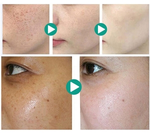 ลดการสังเคราะห์เมลานินแก้ปัญหาการละลายจุดต้านการอักเสบที่เหมาะสม - Product Image 4