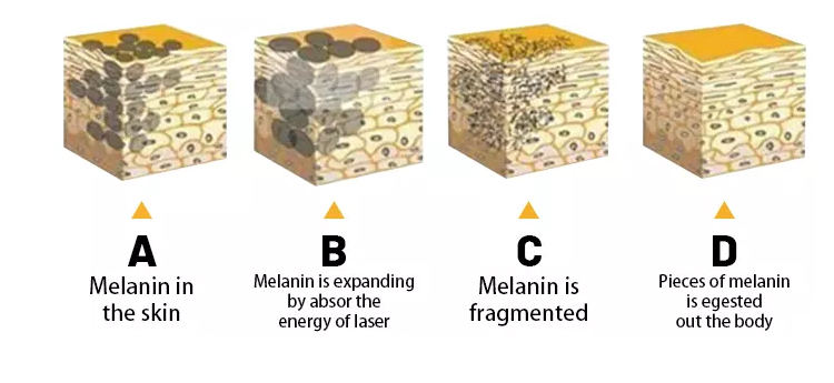 pigment removal