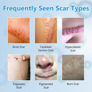 Silicone Sẹo Tấm Cho Cơ Thể Các Bản Vá Lỗi Hiệu Quả Trong Làm phẳng Hypertrophic Sẹo Và Fading Keloids - Product Image 3