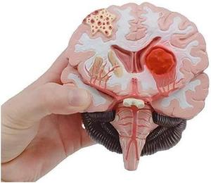 Medizintechnik menschliches Organ pathologisches Hirnanatomie-Modell zeigt die pathologische Hirnstruktur von Schlaganfall - Product Image 5