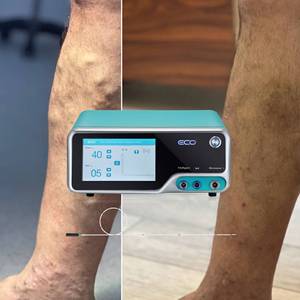 Système thérapeutique à micro-ondes d'ablation tumorale 2450MHz générateur à micro-ondes écologique pour l'ablation thyroïdienne et l'ablation endoveineuse - Product Image 3