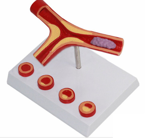 <strong>Human</strong> Blood Vessel Magnification Model Thrombus Model Blood Vessel Model - Product Image 4