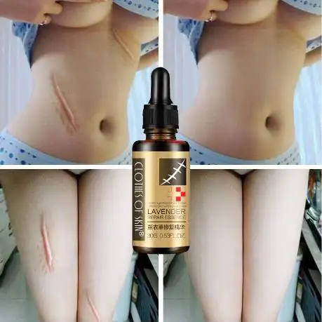 Logo personalizzato donne incinte acido ialuronico olio di siero essenziale per il viso rimozione cicatrice essenziale per il massaggio olio di lavanda