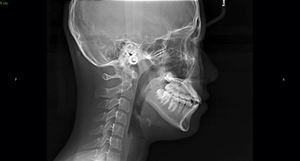 牙科器械口腔单元数字Cbct 3D OPG x光CT扫描仪MSLDX20带头影测量功能 - Product Image 2