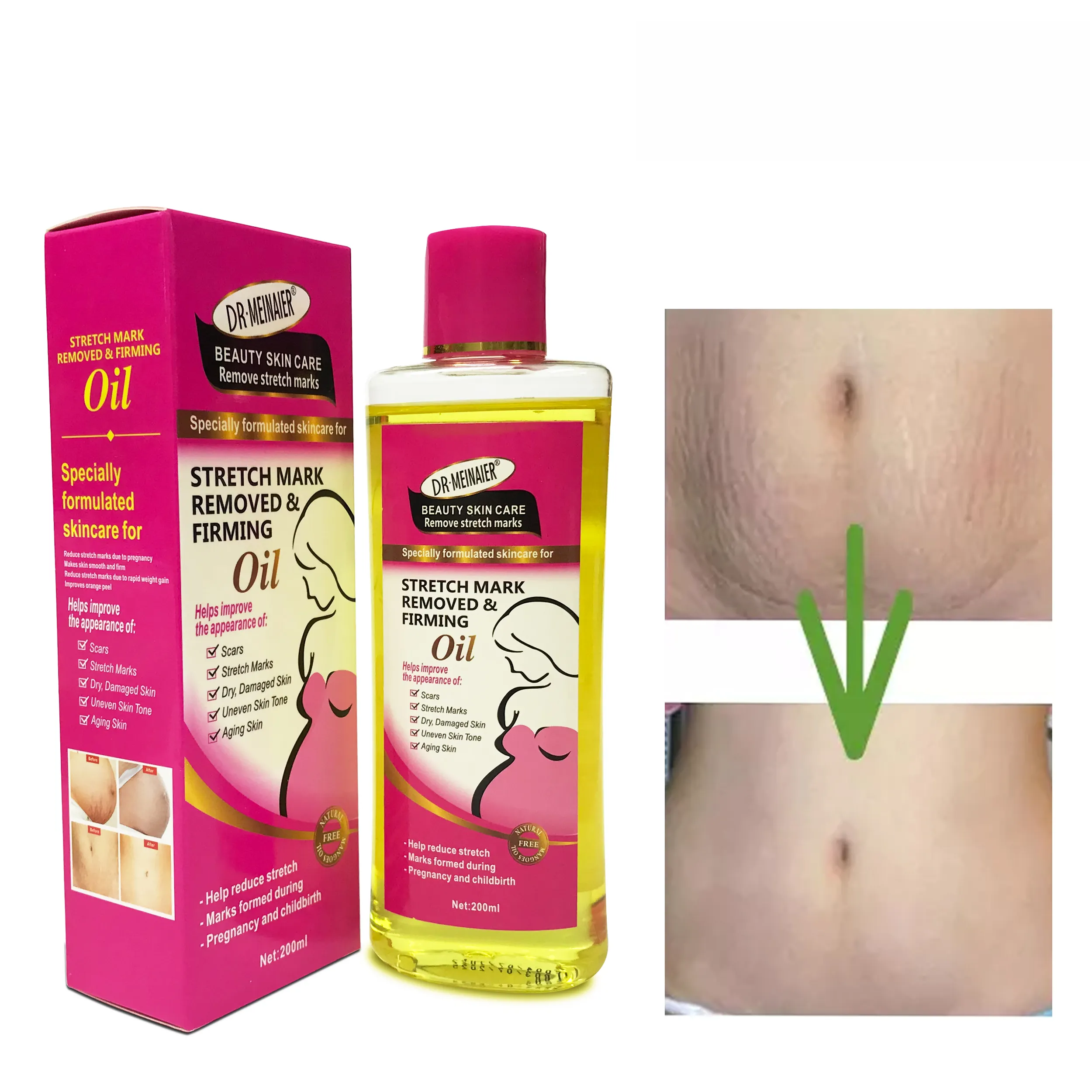 Óleo natural de marca elástica, óleo para mulheres para remover cicatrizes hidratante nutritivo refrescante óleo de ervas