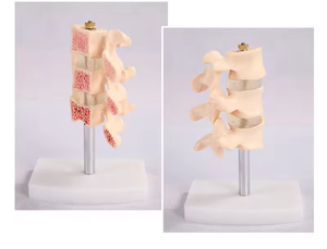 SCIEDU 2 Teile Osteoporose Läsion modell Wirbelsäulen-und Zervix dissektion gelenk modell Menschliche Anatomie Lendenwirbel modell - Product Image 2