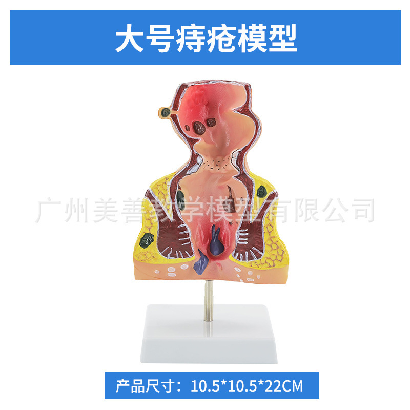Pathology of rectal hemorrhoids - Large size