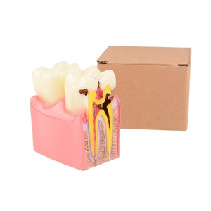 Dental Teeth Model Dental Caries Tooth Model for Patient Education and <strong>Explanation</strong> - Product Image 4