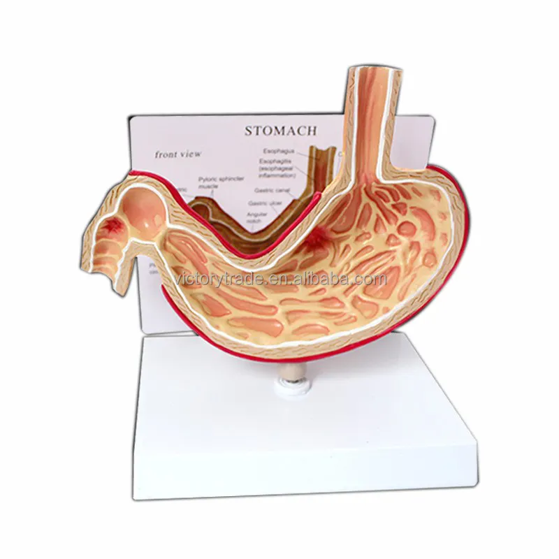 V-AM006 عالية الجودة تشريح الأعضاء البشرية المعدة المريضة تشريح المعدة نموذج للتدريس