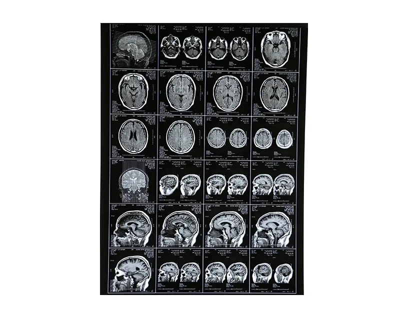 Película térmica de rayos X médica CT Scan 14x17 pulgadas película de rayos X película médica para Agfa Drystar 5302