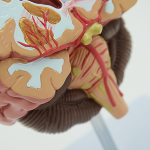 Medizintechnik menschliches Organ pathologisches Hirnanatomie-Modell zeigt die pathologische Hirnstruktur von Schlaganfall - Product Image 3