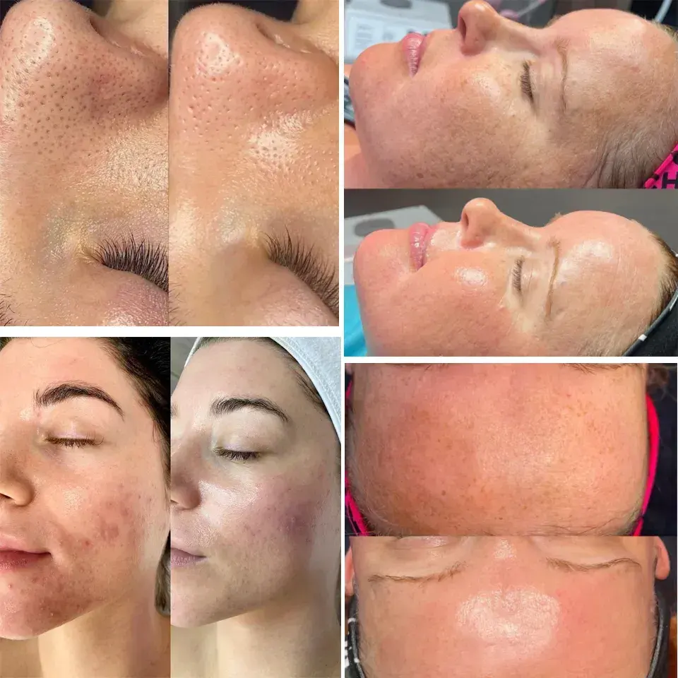 Korea 14 in1 Ästhetik Derma brasion Gesichts reinigung Hydro Gesichts handstück Schönheits klinik Maschine