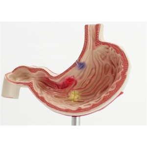 Factory PVC Anatomical Model for Gastric Pathology Perforation and Ulcer Section Enhanced Communication Reduction <strong>Explanation</strong> - Product Image 5