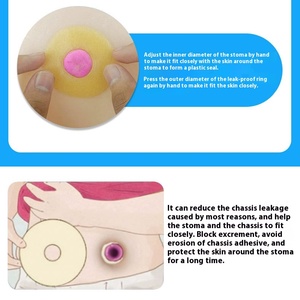 วงแหวนป้องกันการรั่วของ Stoma เติมช่องว่างเว้าเพื่อปกป้องปากผิวหนังและป้องกันการรั่วซึม - Product Image 5