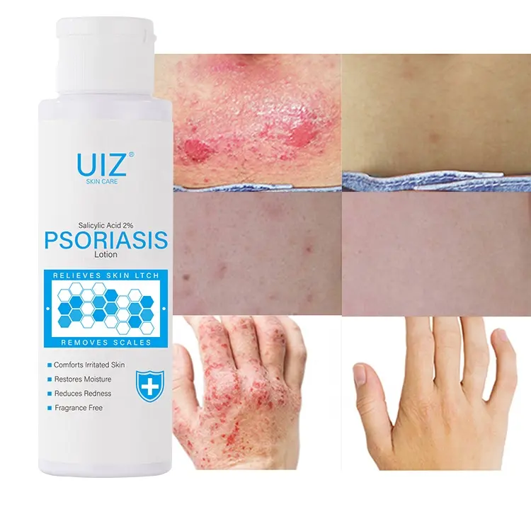 Hot Selling 100G Psoriasis Ekzem Behandlung Körper lotion für trockene juckende empfindliche Haut stellt Feuchtigkeit wieder her