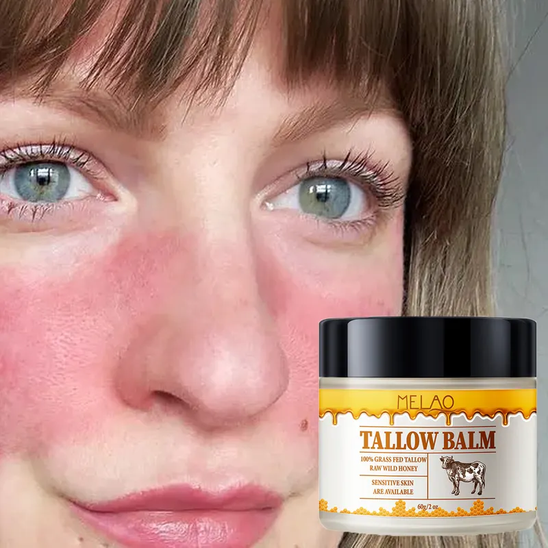 Bálsamo anti-acne para rosto, tratamento de eczema e vermelhidão sensível, hidratante calmante para a pele, remédio contra queimaduras, vitamina, bálsamo de sebo de carne