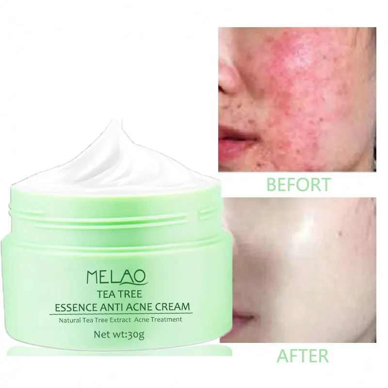 Mejor té verde oem anti-Acné eliminar un acné El melasma grano tratamiento cicatriz raíz Rosa Crema para el acné tratamiento crema de Corea