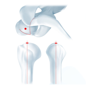 Geasure Stock Ortho pä discher chirurgischer Humerus nagel für die osteoporo tische Knochen fixierung Medizinisch-ortho pä disch - Product Image 3