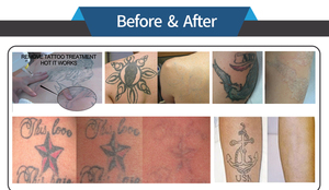 Q Switched ND Yag laser Loại bỏ hình xăm Máy 2023 Q chuyển đổi Yag laser Neodymium Nd Yag Loại bỏ hình xăm - Product Image 3