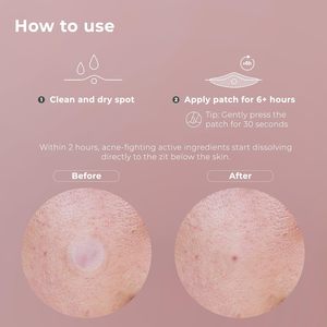 S microneedle hydroקולואיד פצעון תיקון סליצילית & חומצה היאלורונית pimple עבור פגמים נקודה כהה & סיסטיק