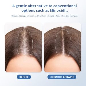 Serum pertumbuhan rambut Rosemary Roll-on 25 ml DHT-Blocking kulit kepala meningkatkan aliran oksigen 3% Redensyl 2% penata Perawatan Rambut multifungsi - Product Image 2