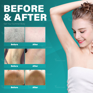 755nm 1064nm dài xung <span class=keywords><strong>Diode</strong></span> Nd Yag máy laser để bán nhẹ nhàng với làm mát vĩnh viễn alexandrite Laser tóc loại bỏ thiết bị - Product Image 6