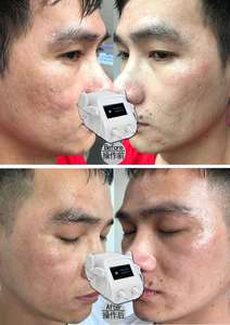 Double Handles Professional Tixel Thermal Acne Scar <strong>Removal</strong> and Stretch Marks <strong>Removal</strong> Machine for Facial for Body - Product Image 6