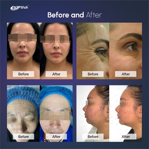 Nhà sử dụng thiết bị làm đẹp chuyên nghiệp mặt nâng lên <span class=keywords><strong>RF</strong></span> để nâng mặt - Product Image 3