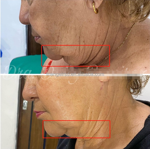 أحدث شفط الدهون بالليزر ديود 980 نانومتر 1470 نانومتر ليزر تحلل الدهون لمكافحة السيلوليت آلة رفع الوجه إندو ليزر رفع - Product Image 6