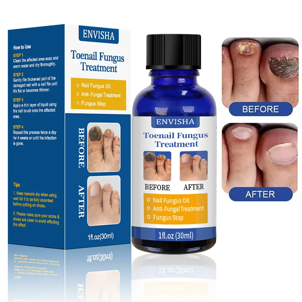 Gel antifongique pour les ongles, traitement pour les ongles, blanchiment des ongles des orteils, Gel Anti-Infection pour la Paronychia