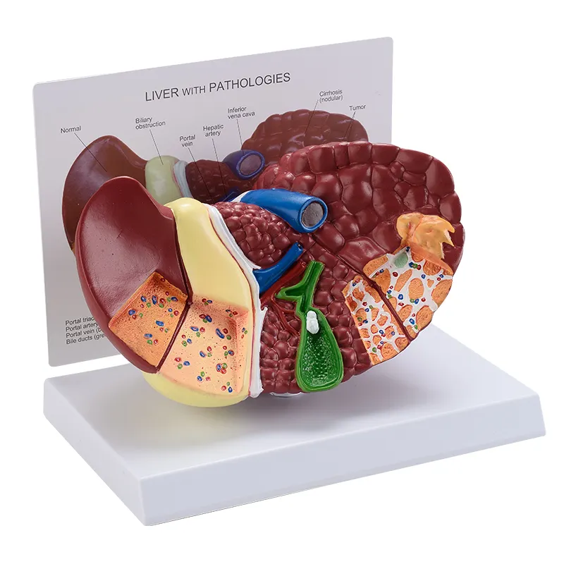 Modello anatomico di malattia del fegato umano di scienza medica