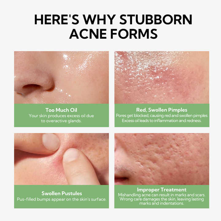 LANBENA Skin Care Anti Acne Serum with 5% Niacinamide + 2% Salicylic Acid Serum for Skin Repairing Clears Improves Marks