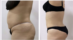 Le plus récent Endolaser 1470nm 980nm Diode Laser Lifting du visage Liposuccion Liposuct Endo Laser <span class=keywords><strong>Lift</strong></span> - Product Image 5