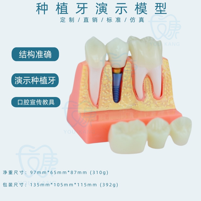 Implant dentaire B, fond jaune, clou bleu.