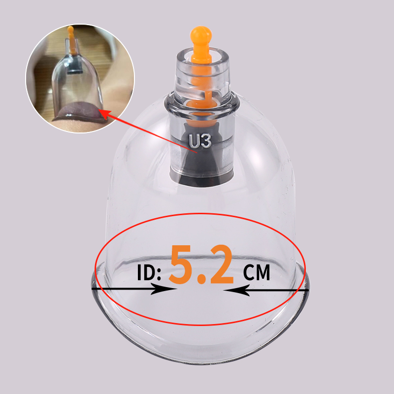 U3 (courbe ventouses, OD: 5.2cm ± 0.2cm)