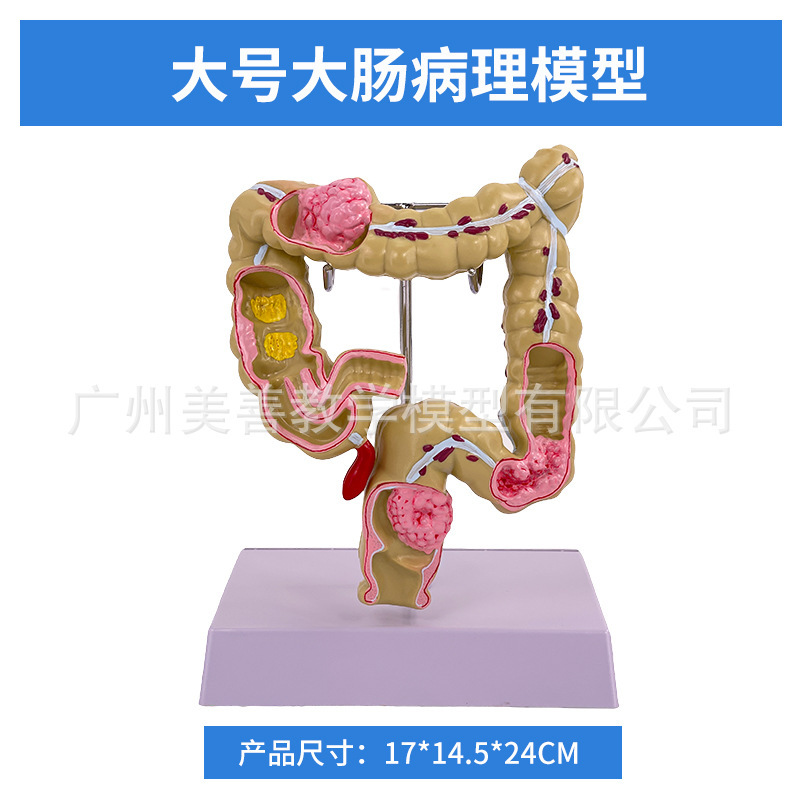 Large colorectal pathological model (size) 17*15*24