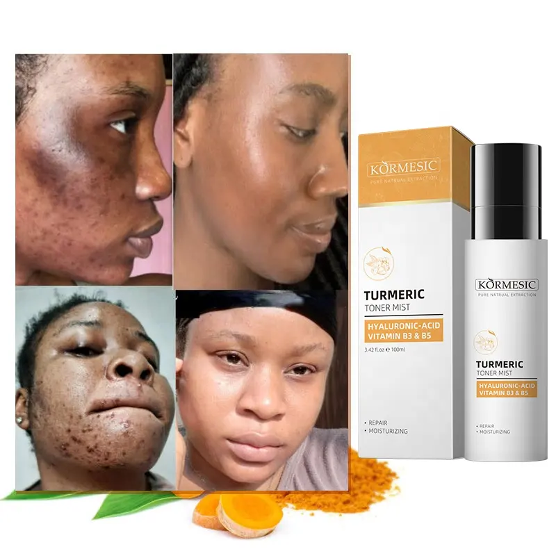 Toner facial de iluminação forte e turmeric, rótulo privado, hidratante, clareamento, tratamento de acne, toner de rosto