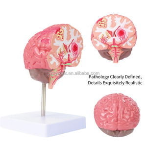 Scienza medica organo umano patologico del cervello modello di anatomia del cervello che mostra ictus emorragia cerebrale aneurisma strutture cerebrali - Product Image 4