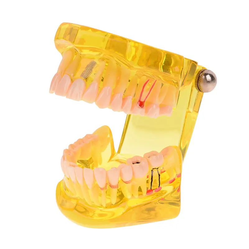 Produsen grosir model jembatan oral model gigi implan gigi kekuatan tinggi NM400 pabrik manufaktur