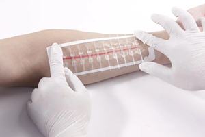 Y tế tùy chỉnh dùng một lần vô trùng Dải gia cố da dây kéo vết thương da đóng cửa thiết bị - Product Image 2