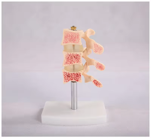 SCIEDU 2 Teile Osteoporose Läsion modell Wirbelsäulen-und Zervix dissektion gelenk modell Menschliche Anatomie Lendenwirbel modell - Product Image 5