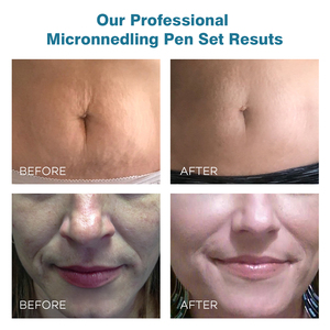 Amazon Sự Lựa Chọn Derma Con Lăn Kit 0.25 Mm Với Vitamin C Huyết Thanh Cho Khuôn Mặt Cơ Thể Loại Bỏ Vết Sẹo Đầu Cho Salon Sử Dụng - Product Image 3