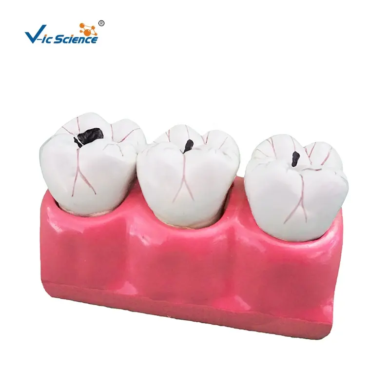 Modelo de caries dental modelo de yeso dental modelo de diente recortador en ciencia médica