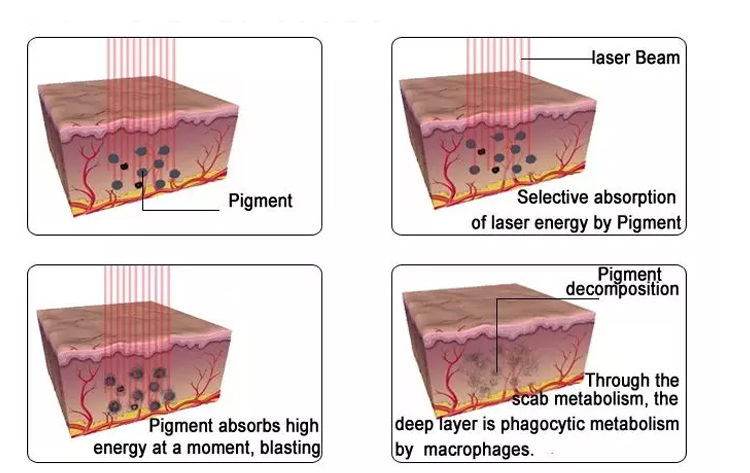pigment removal